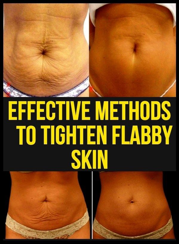 Featured image of post How To Tighten Loose Skin On Stomach Naturally