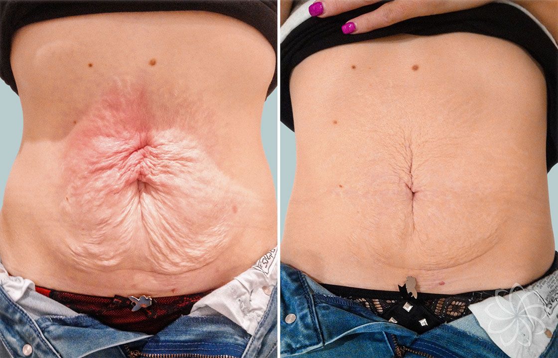 Featured image of post How To Tighten Loose Skin On Stomach With Surgery