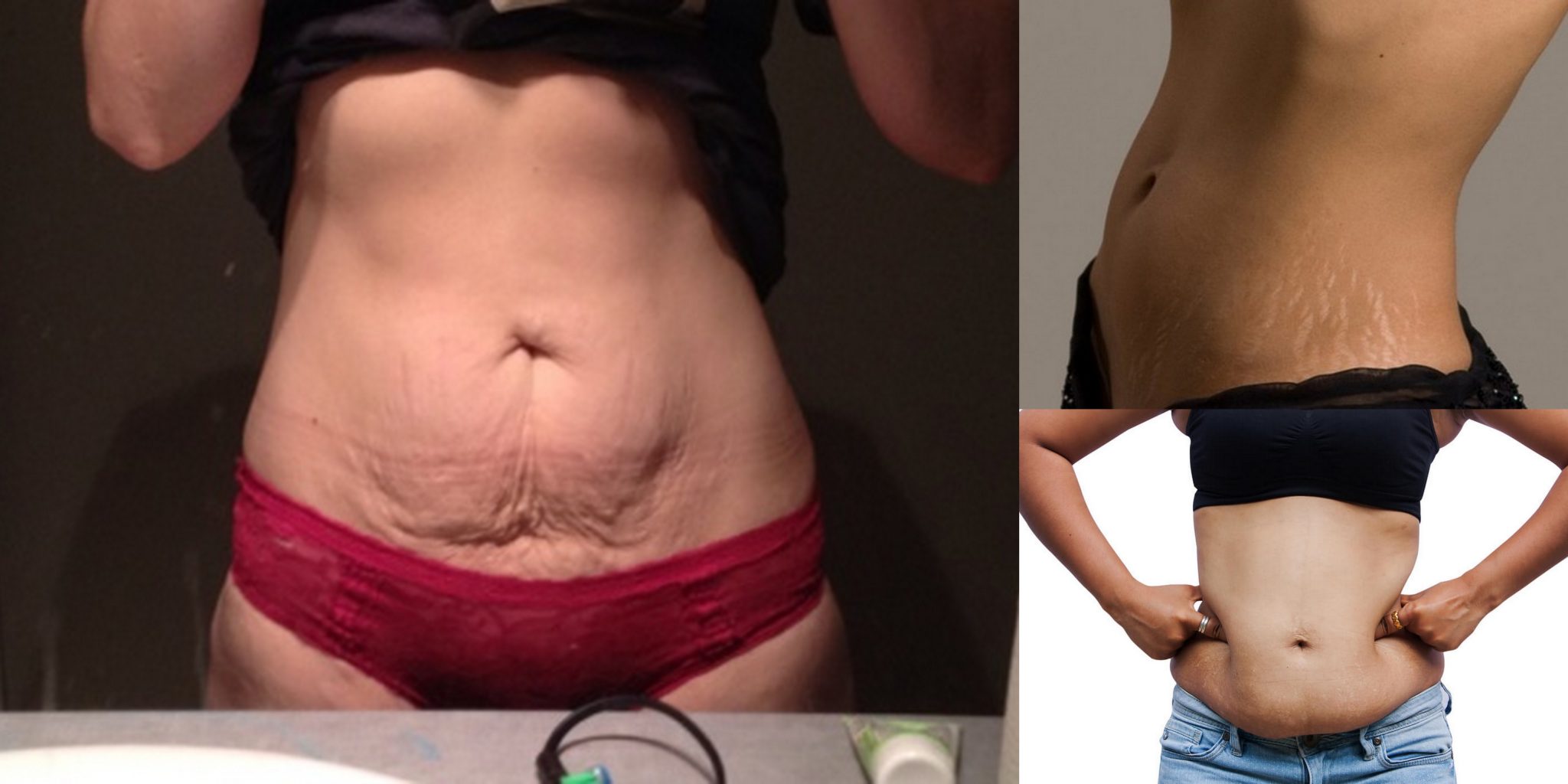 Featured image of post How To Tighten Loose Skin On Stomach Without Surgery